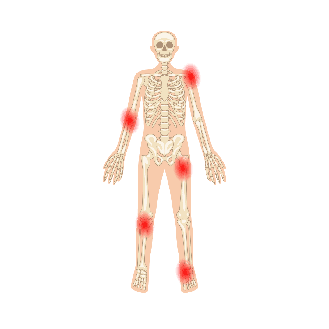  Bursitis