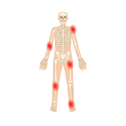  Bursitis