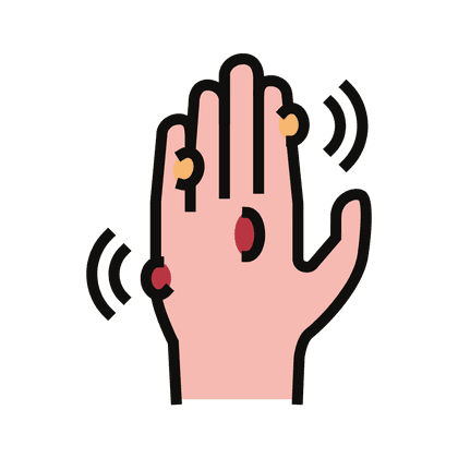 Warts