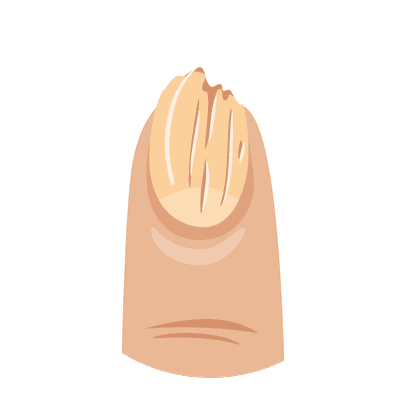 Nail brittleness