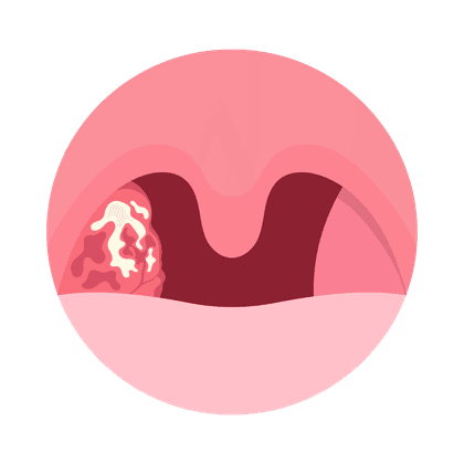 Adenoids